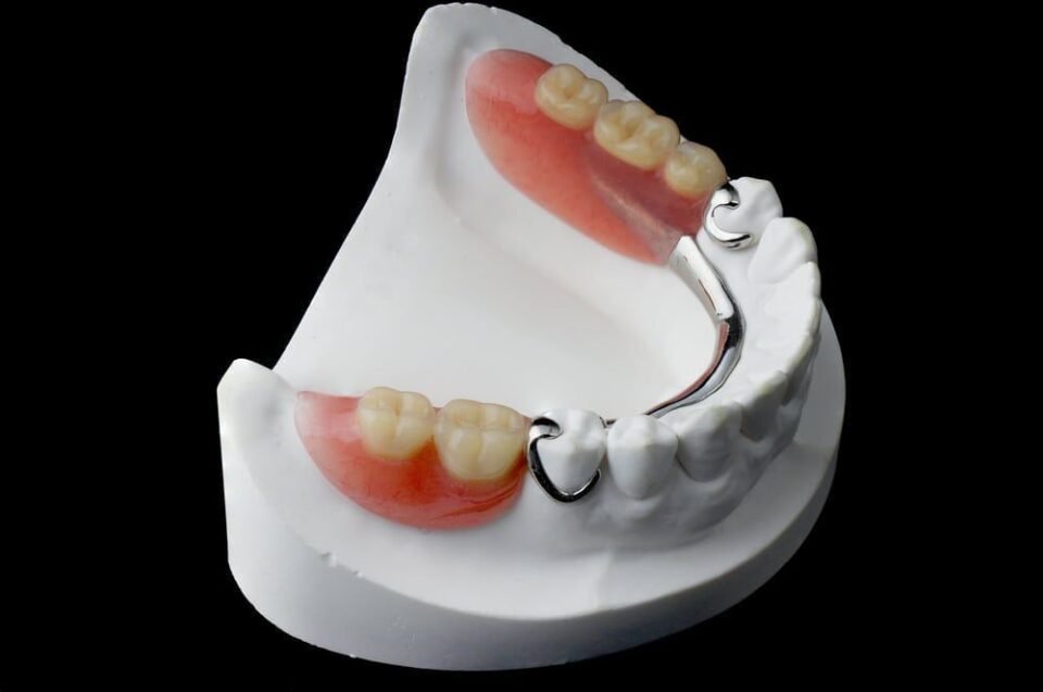metal partial denture