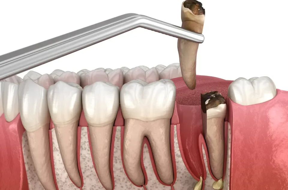 visual of what a teeth extraction looks like